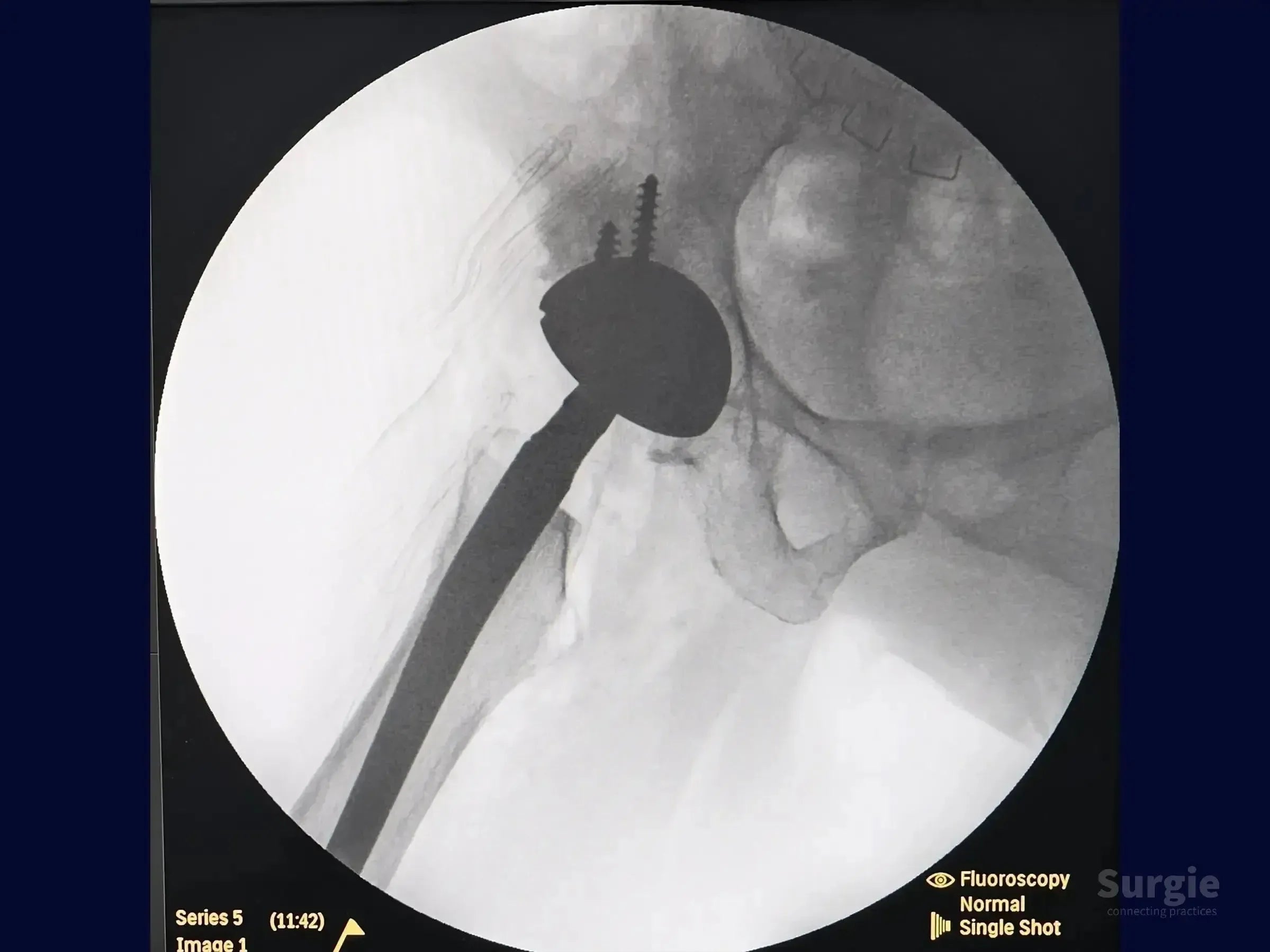 Fluoroscopic X-ray showing a total hip arthroplasty implant with acetabular cup, femoral stem, and fixation screws.