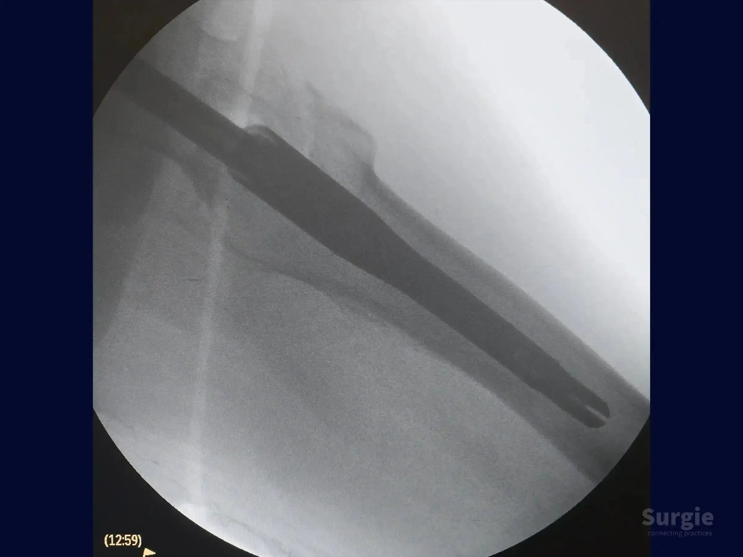 Fluoroscopic X-ray showing an intramedullary nail inserted into a fractured femur for transtrochanteric surgery.