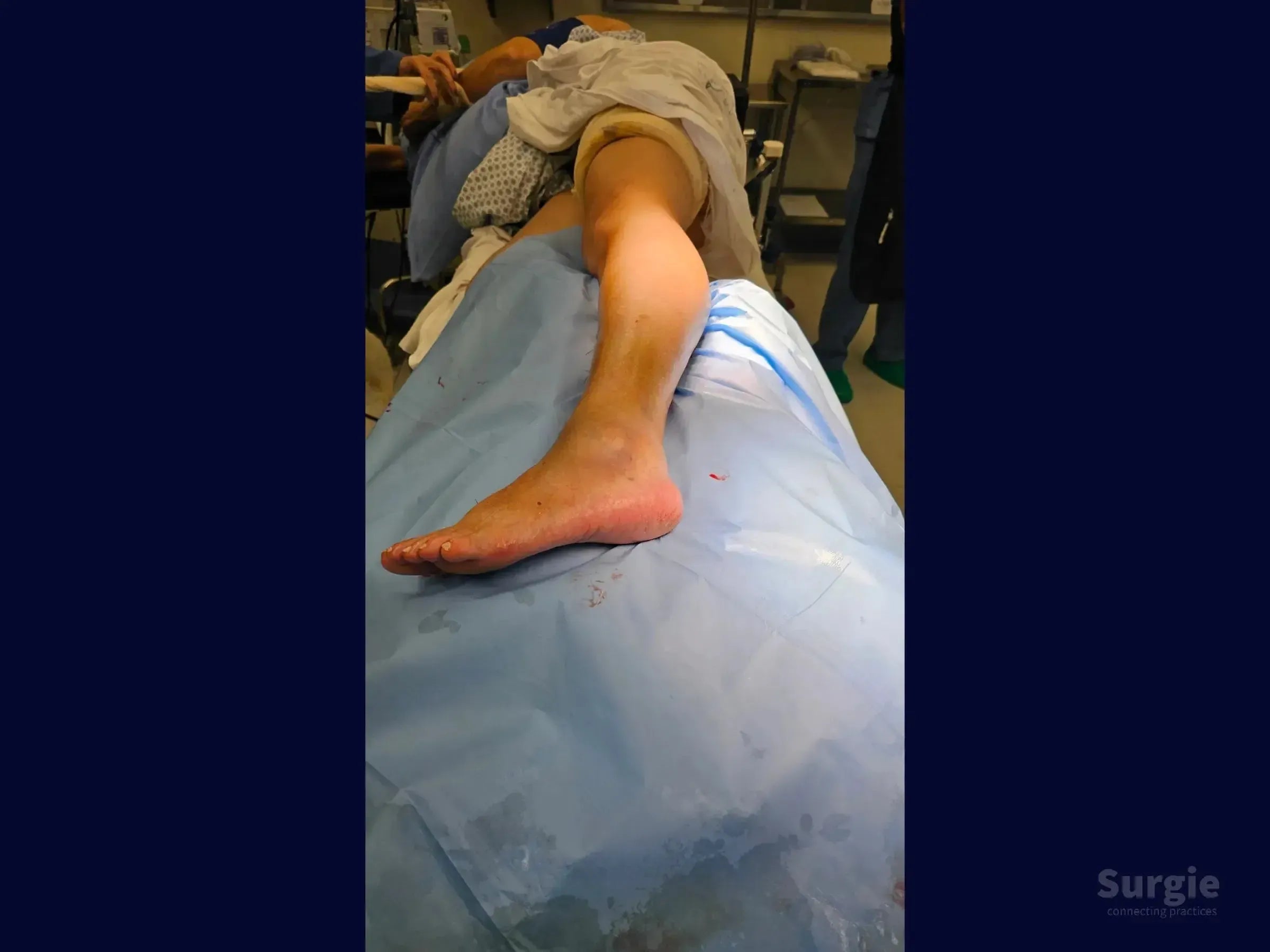 Patient in lateral decubitus position on a blue surgical drape for a trimalleolar fracture reduction procedure.