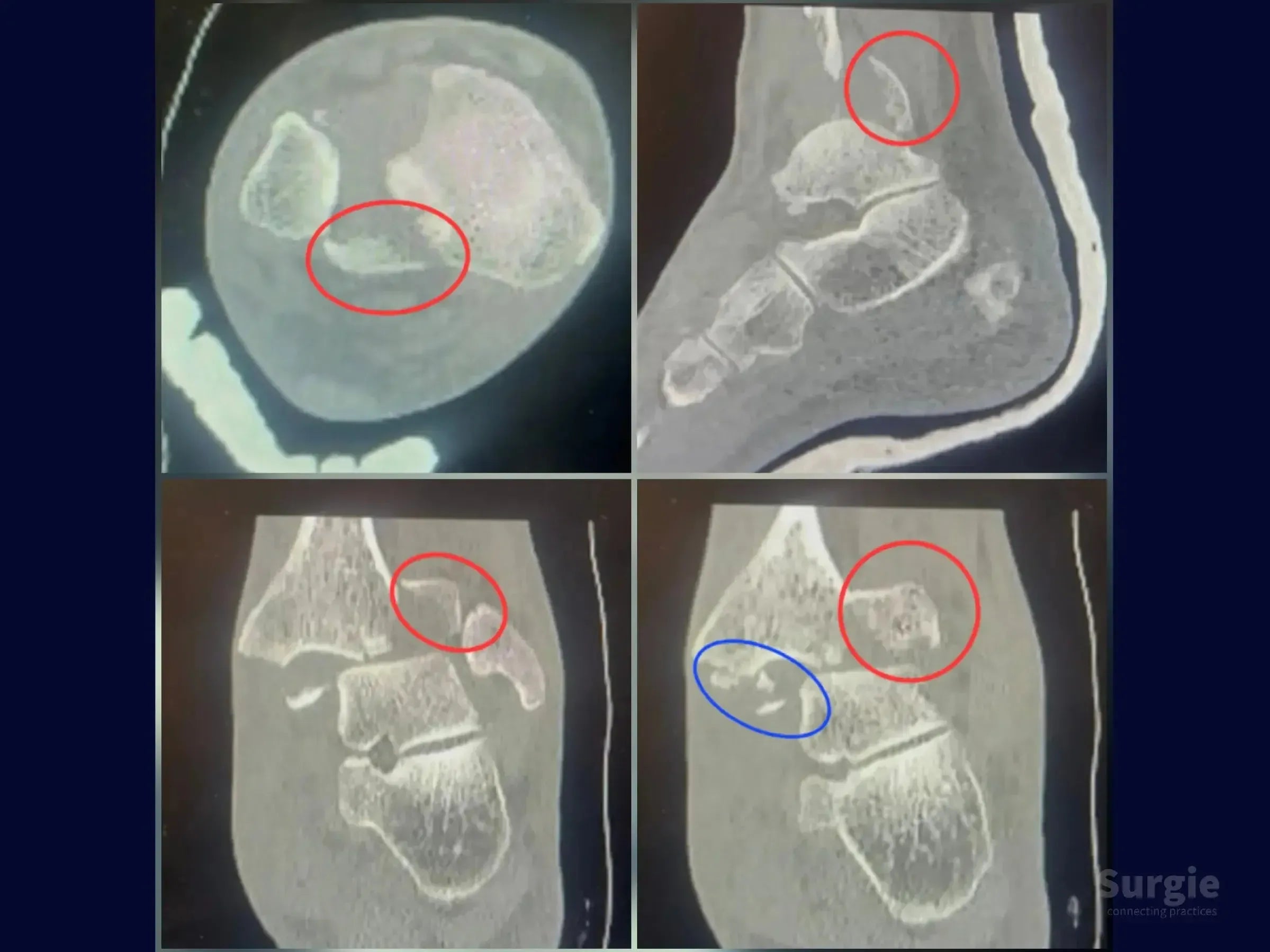 CT scan showing trimalleolar ankle fracture with red and blue circles highlighting bone fragments and joint displacement.