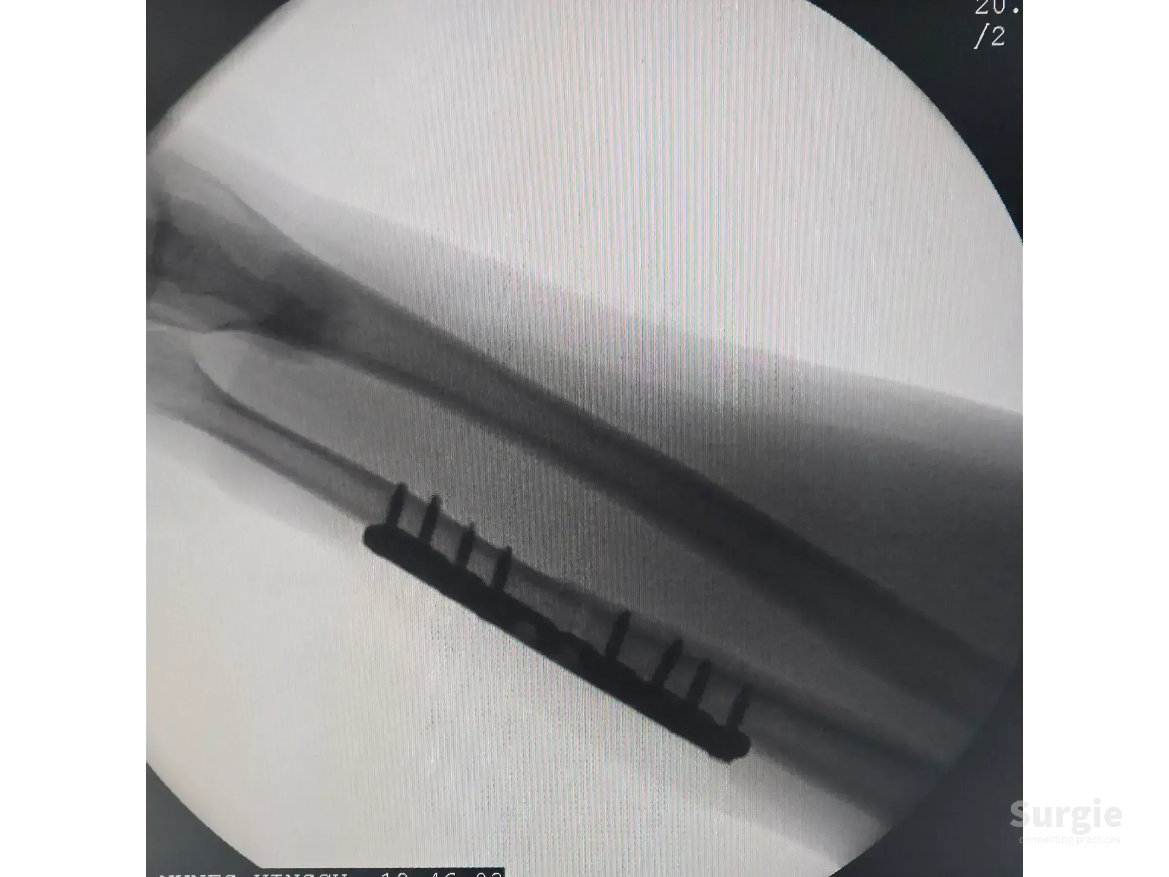 X-ray of an ulnar shaft fracture stabilized with a metal fixation plate and multiple screws for anatomical reduction.
