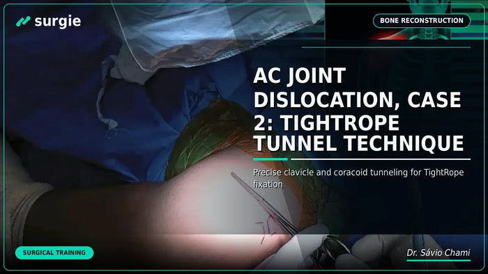 Luxação da Articulação AC, Caso 2: Técnica do Túnel TightRope