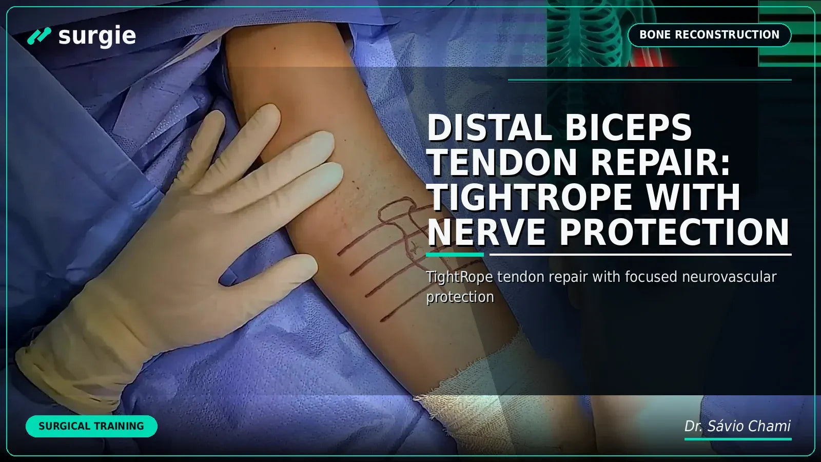 Distal Biceps Tendon Repair: TightRope with Nerve Protection