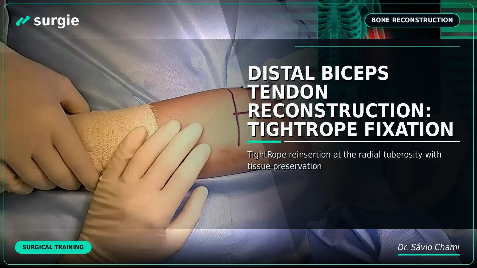 Distal Biceps Tendon Reconstruction: TightRope Fixation