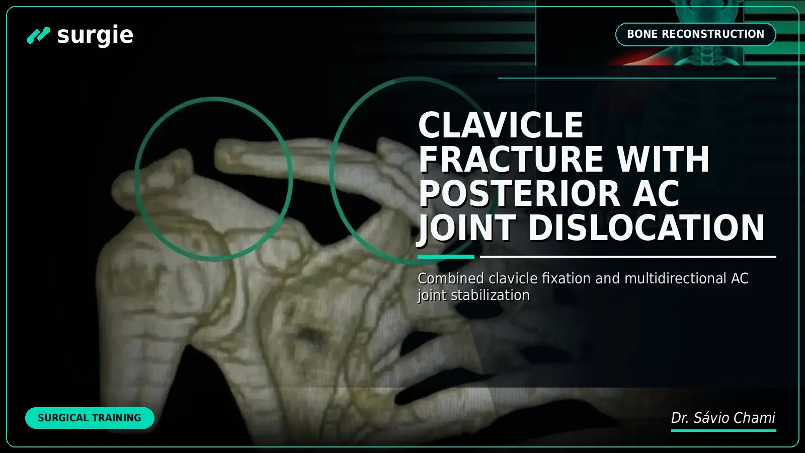 Clavicle Fracture with Posterior AC Joint Dislocation