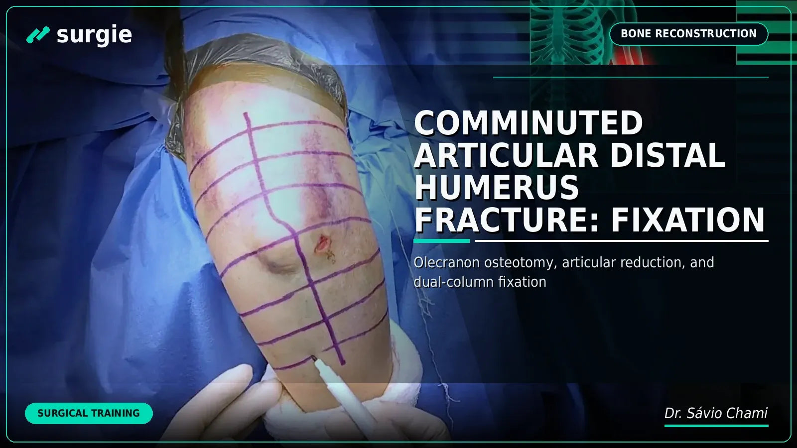 Comminuted Articular Distal Humerus Fracture: Fixation