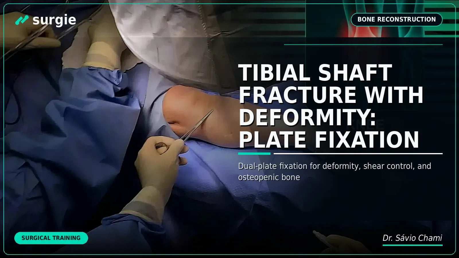Tibial Shaft Fracture with Deformity: Plate Fixation