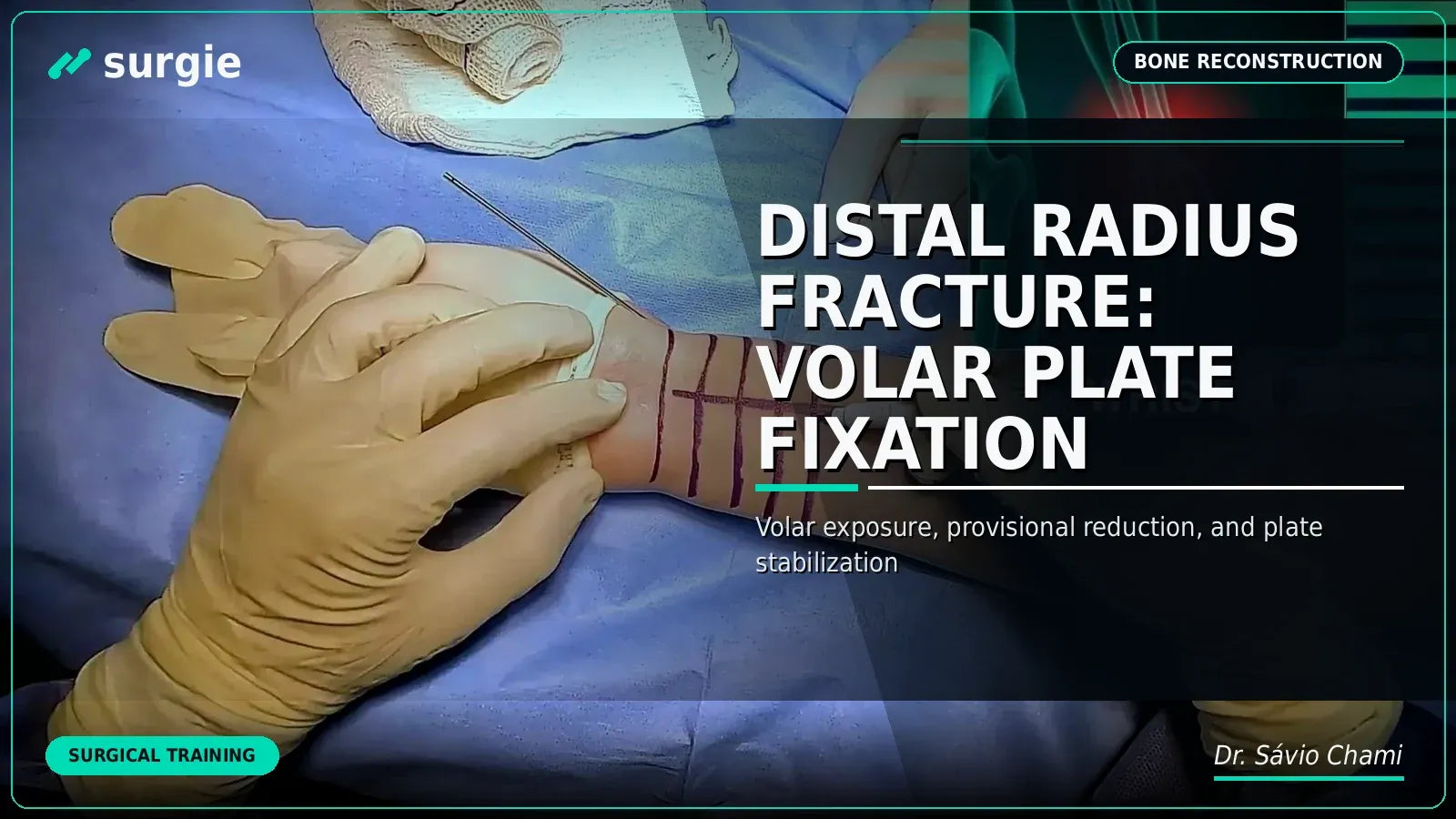 Distal Radius Fracture: Volar Plate Fixation