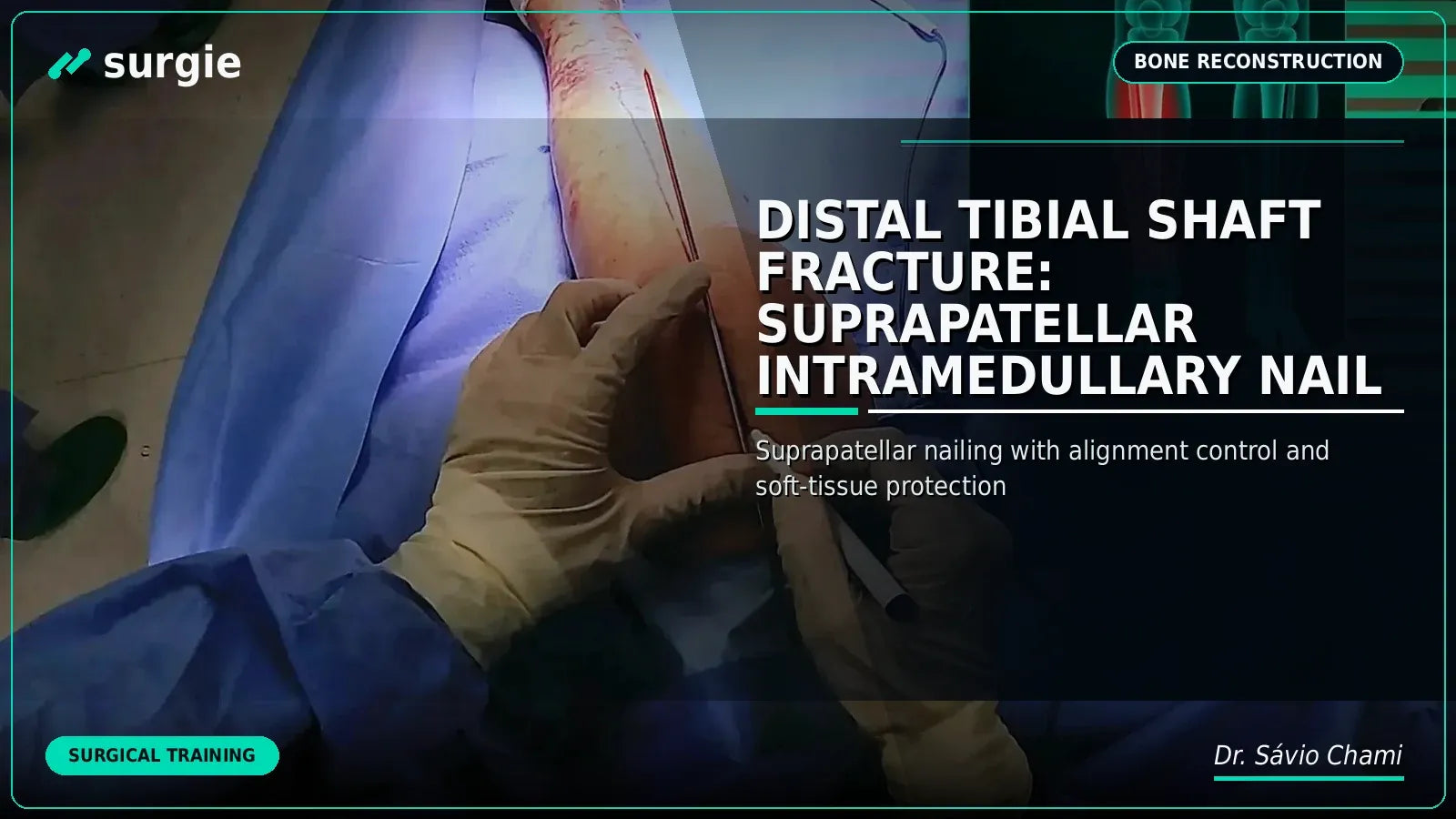 Distal Tibial Shaft Fracture: Suprapatellar Intramedullary Nail