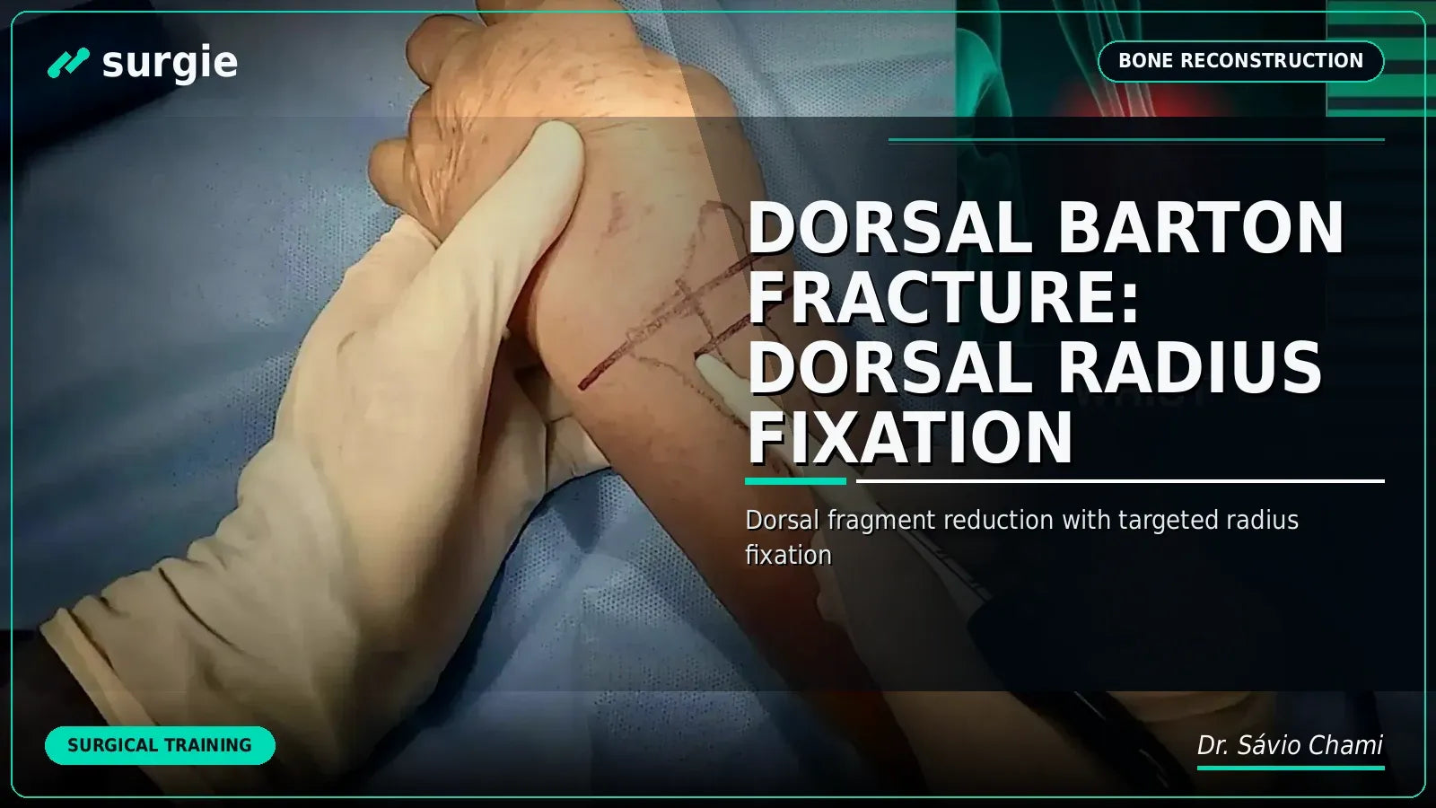 Dorsal Barton Fracture: Dorsal Radius Fixation