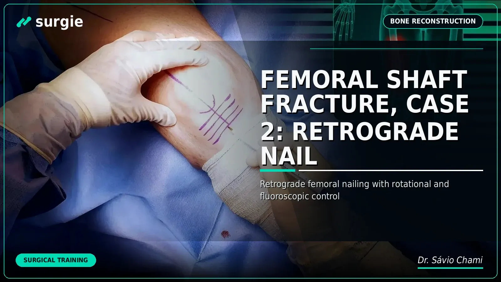 Femoral Shaft Fracture, Case 2: Retrograde Nail