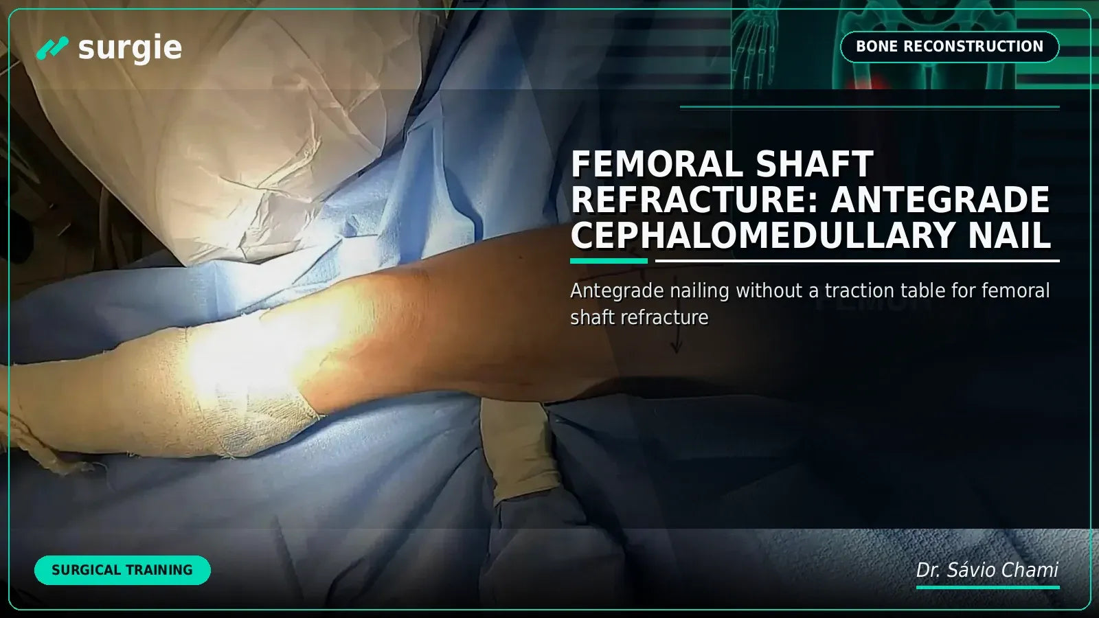 Femoral Shaft Refracture: Antegrade Cephalomedullary Nail