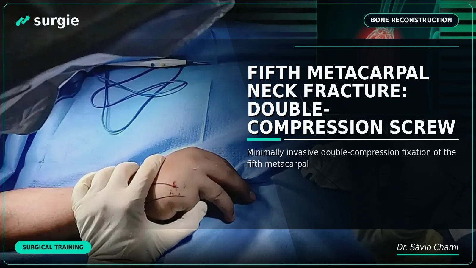 Fifth Metacarpal Neck Fracture: Double-Compression Screw