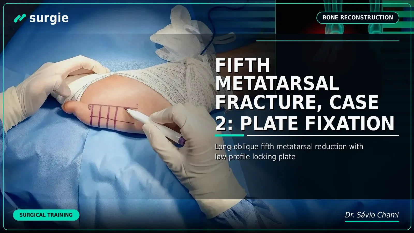 Fifth Metatarsal Fracture, Case 2: Plate Fixation