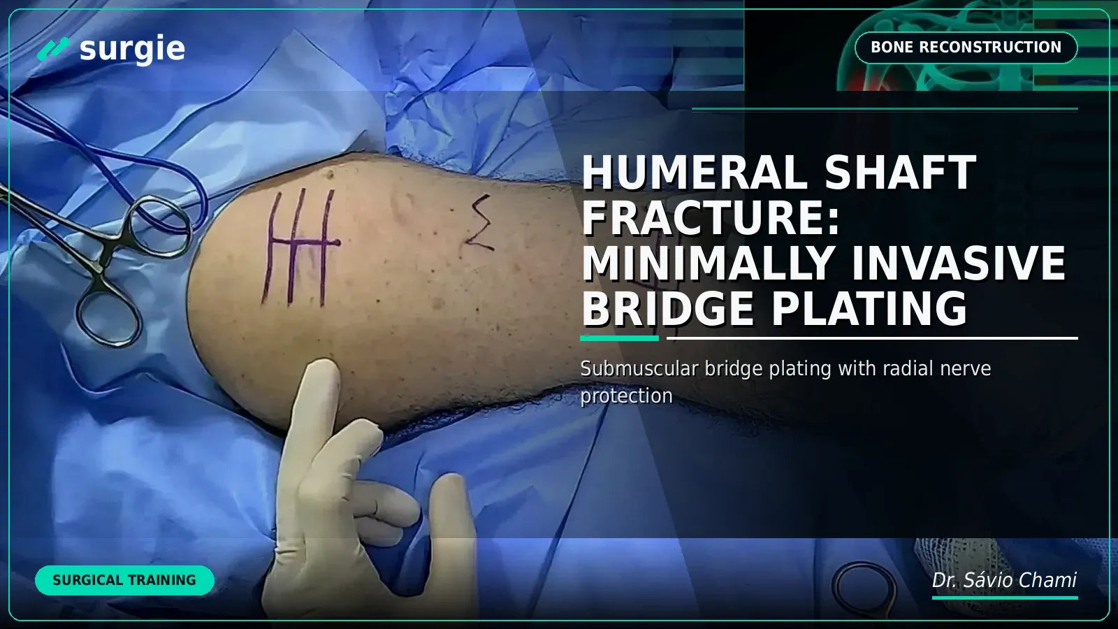 Humeral Shaft Fracture: Minimally Invasive Bridge Plating