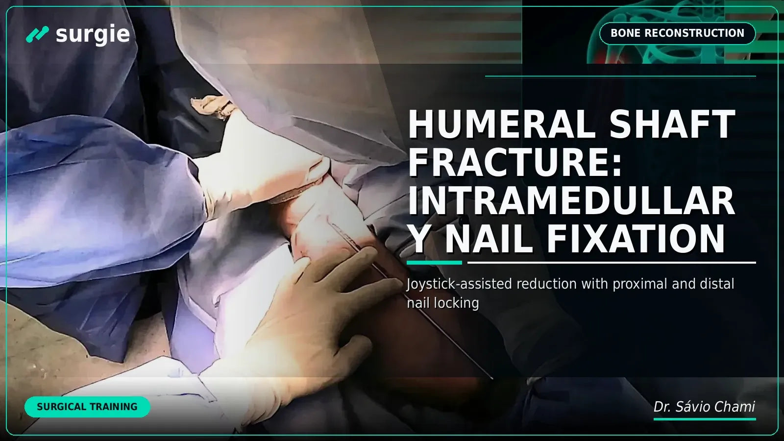 Humeral Shaft Fracture: Intramedullary Nail Fixation