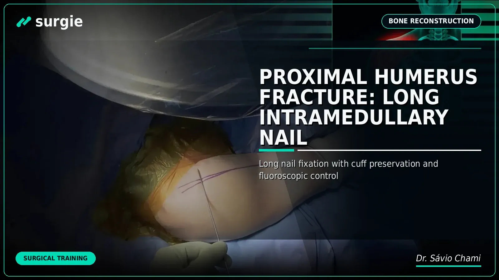 Proximal Humerus Fracture: Long Intramedullary Nail