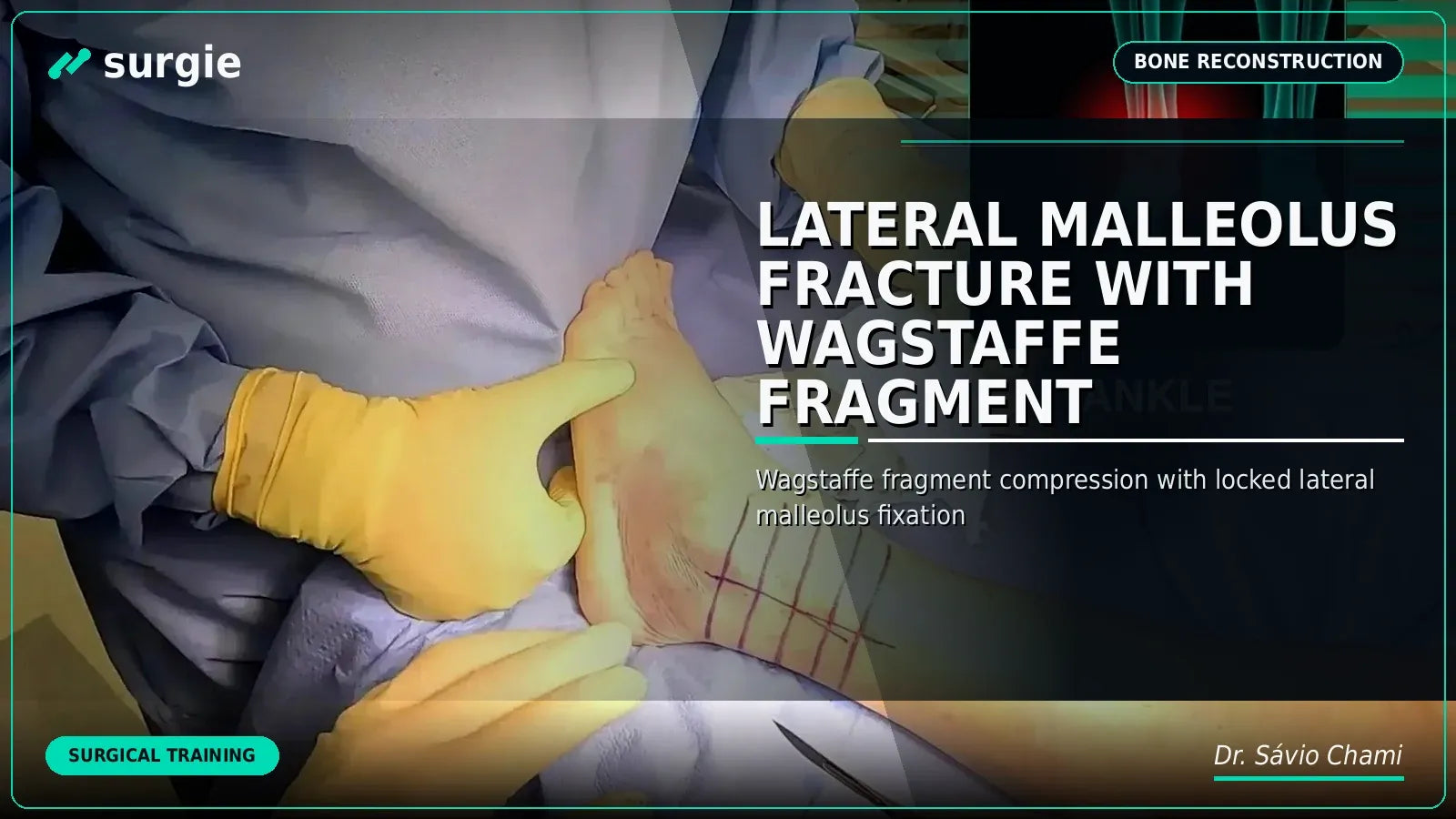 Lateral Malleolus Fracture with Wagstaffe Fragment