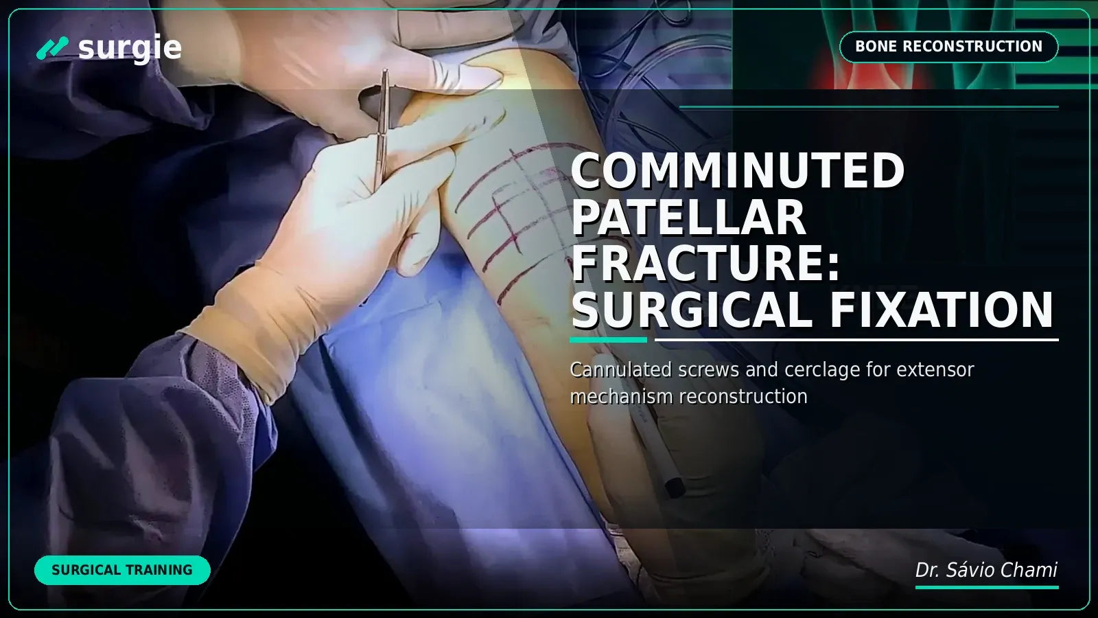 Comminuted Patellar Fracture: Surgical Fixation