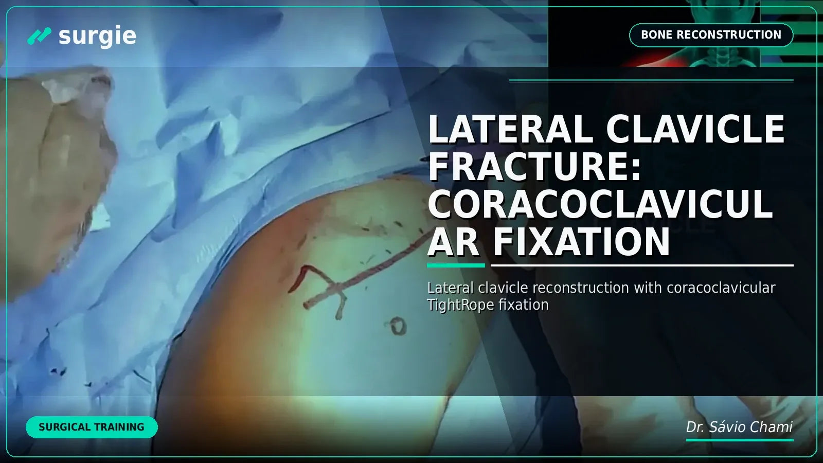 Lateral Clavicle Fracture: Coracoclavicular Fixation