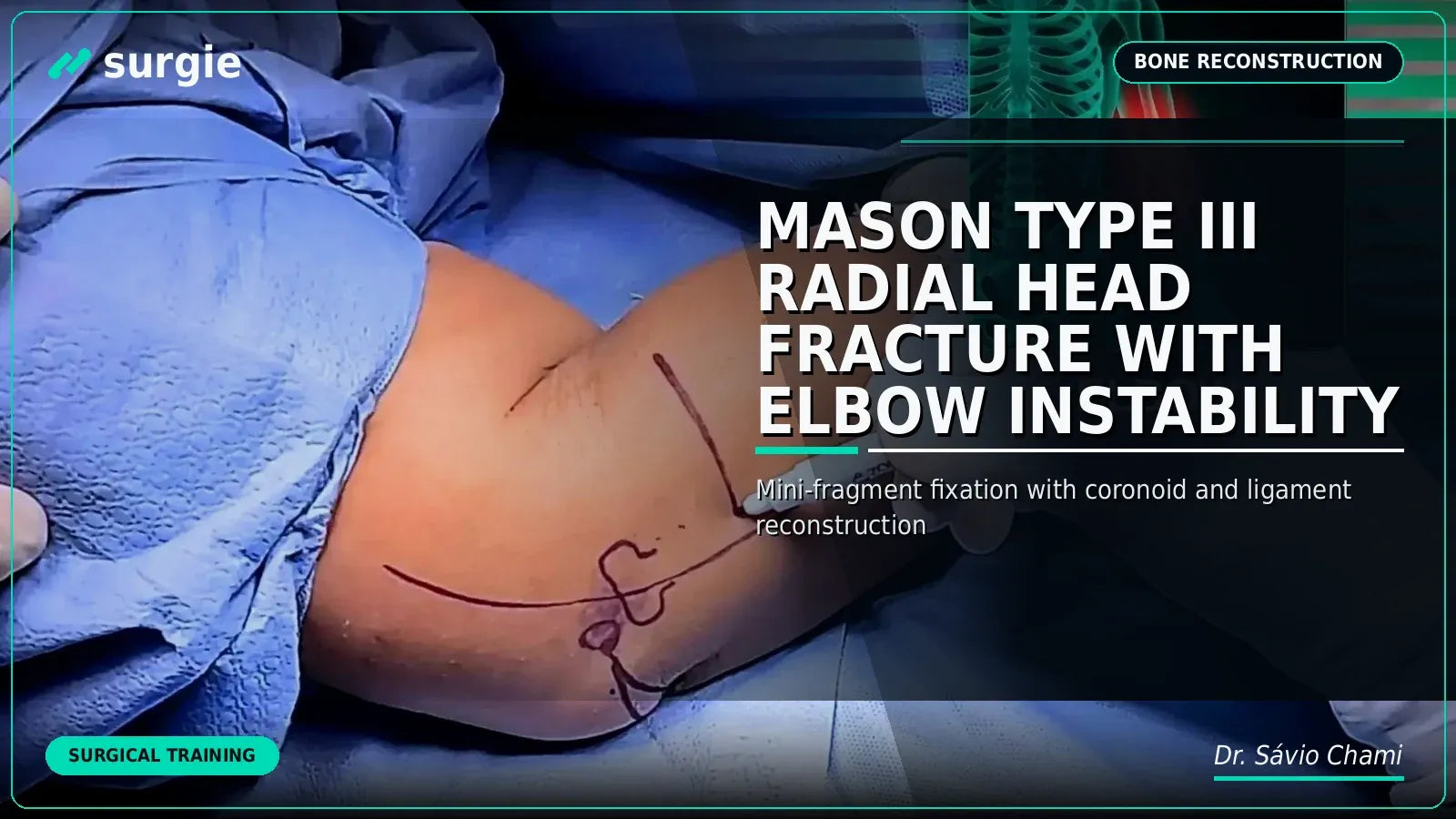 Mason Type III Radial Head Fracture with Elbow Instability