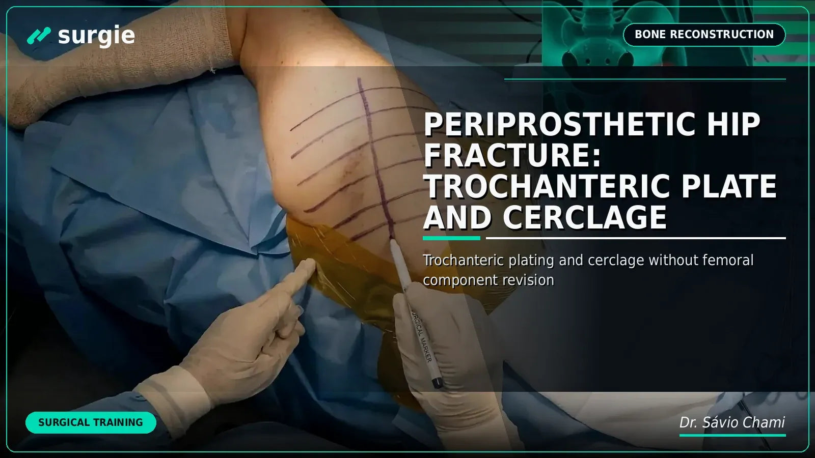 Periprosthetic Hip Fracture: Trochanteric Plate and Cerclage