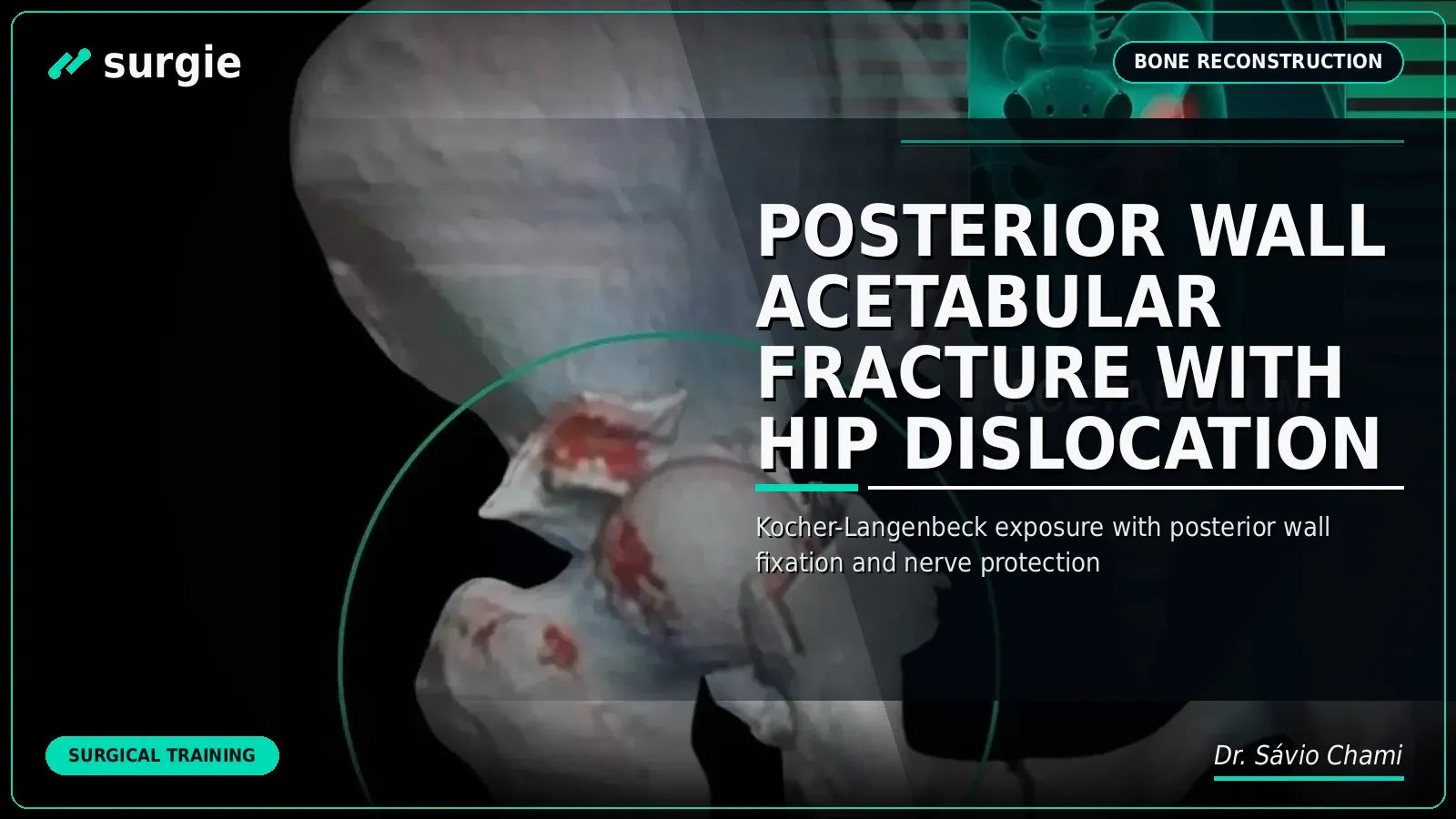 Posterior Wall Acetabular Fracture with Hip Dislocation