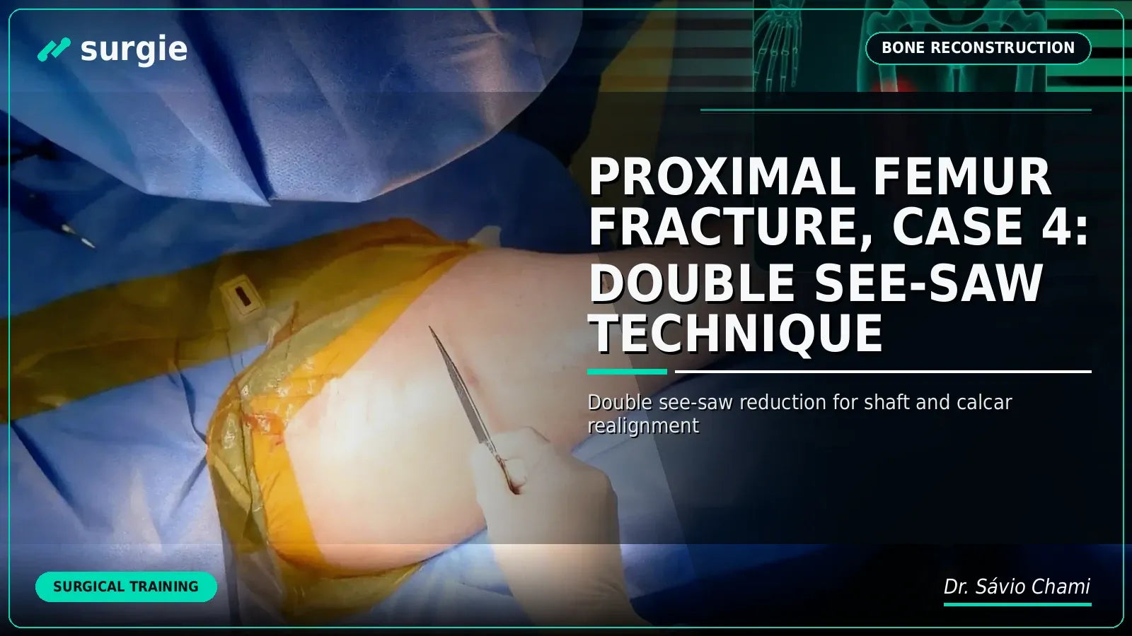 Proximal Femur Fracture, Case 4: Double See-Saw Technique
