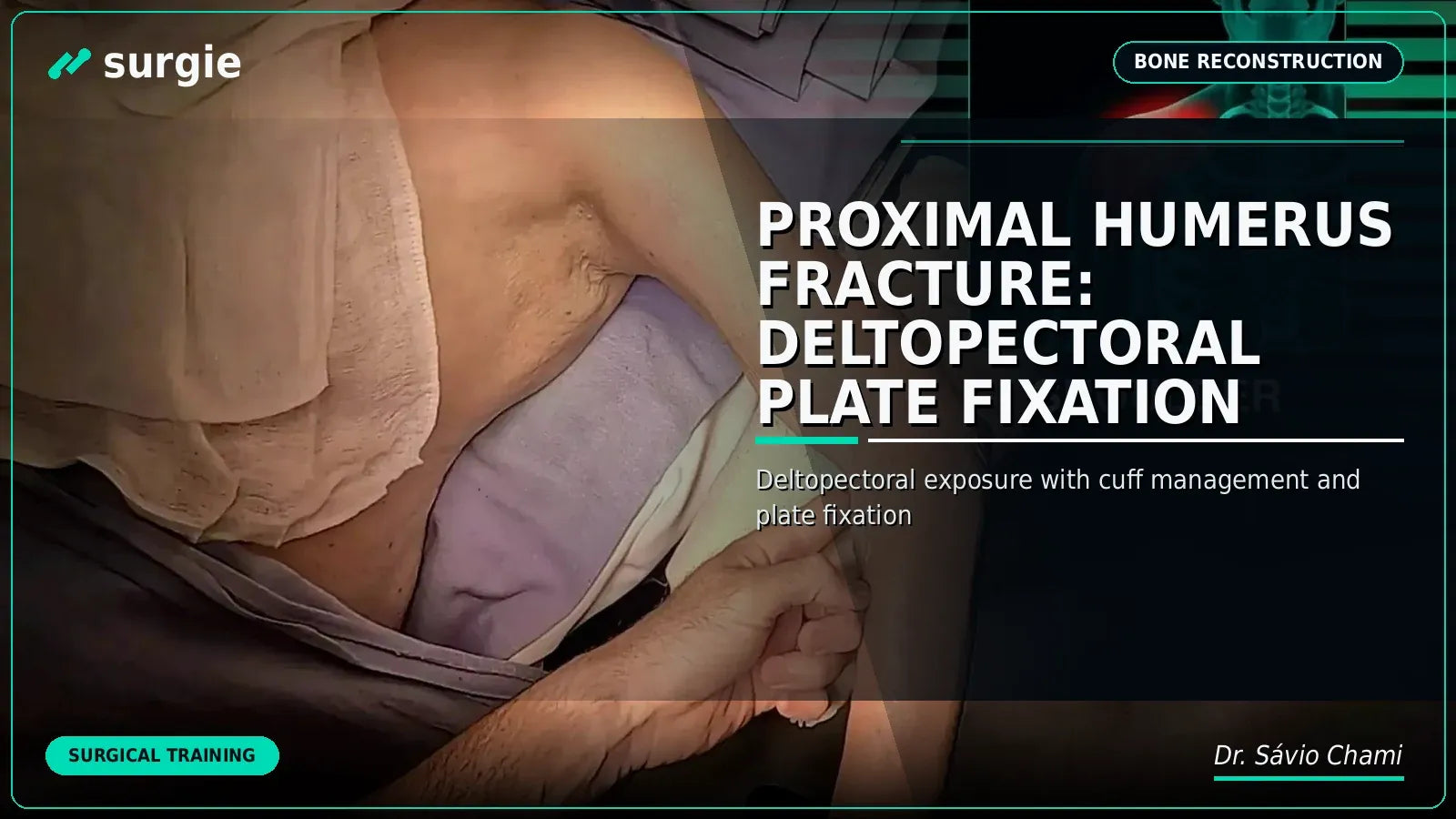 Proximal Humerus Fracture: Deltopectoral Plate Fixation