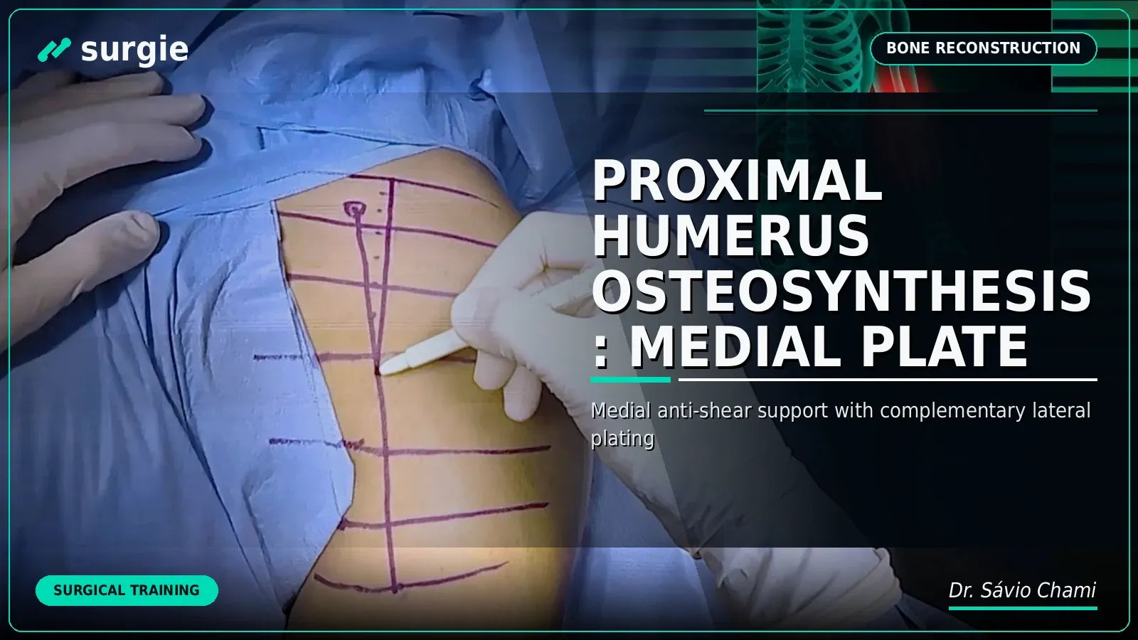 Proximal Humerus Osteosynthesis: Medial Plate