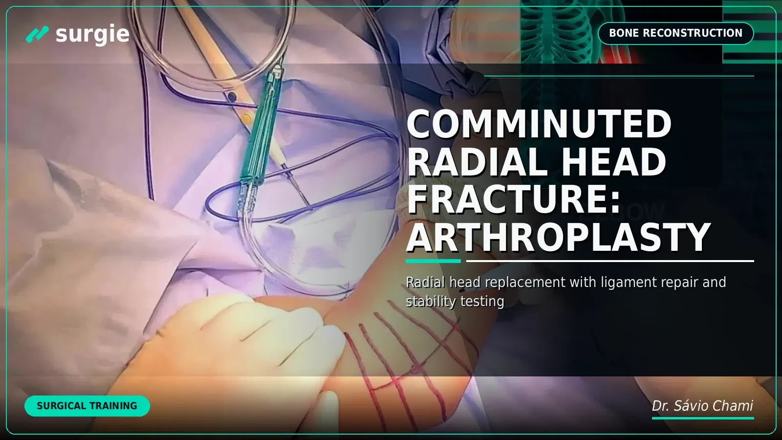 Comminuted Radial Head Fracture: Arthroplasty
