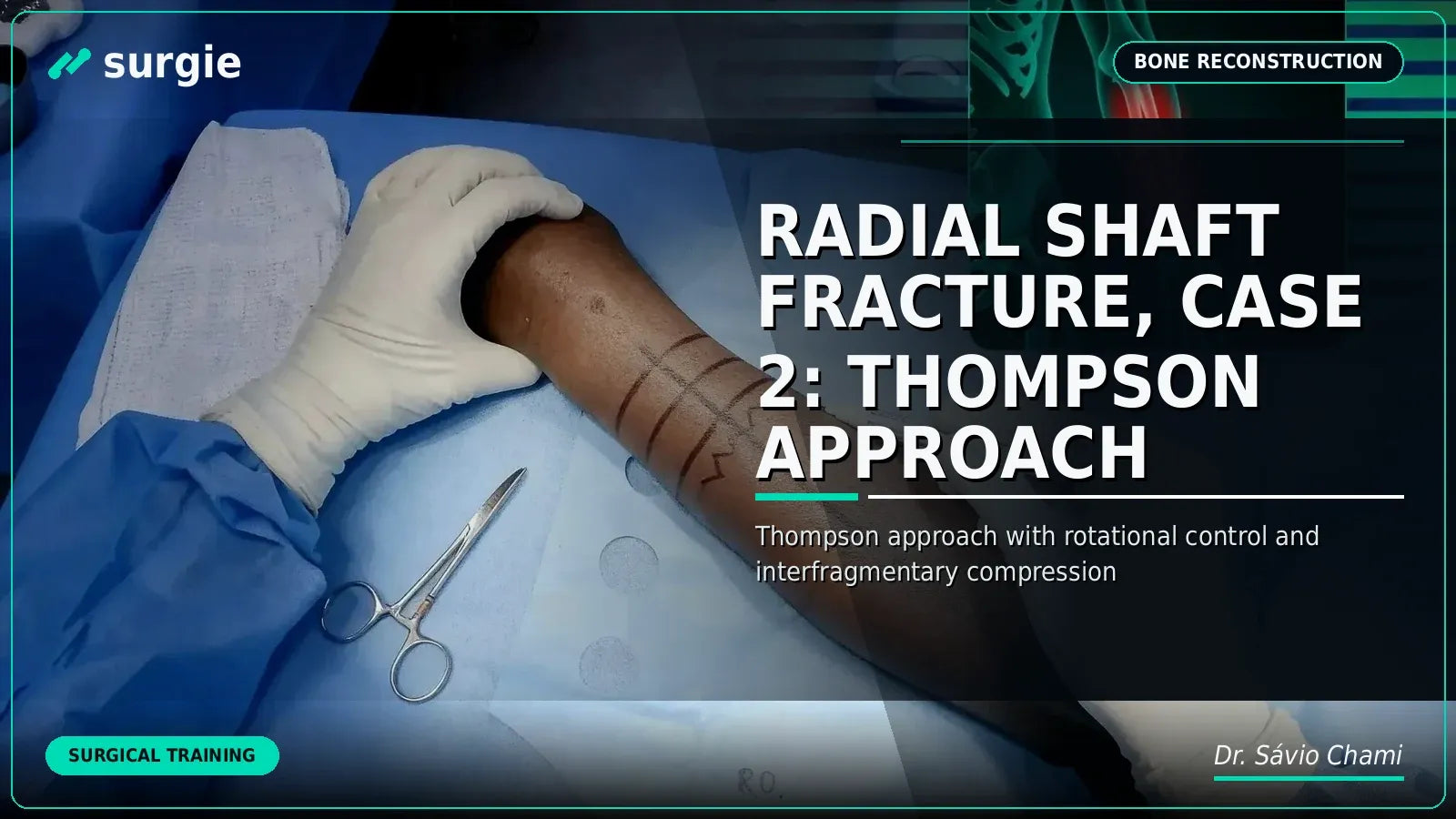 Radial Shaft Fracture, Case 2: Thompson Approach