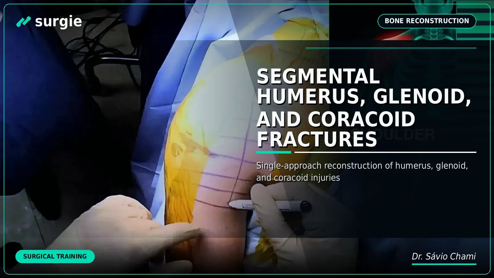 Segmental Humerus, Glenoid, and Coracoid Fractures