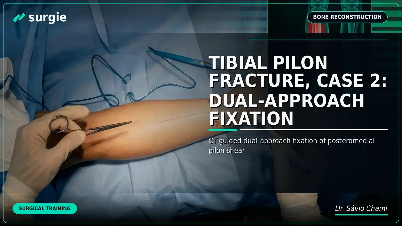 Tibial Pilon Fracture, Case 2: Dual-Approach Fixation