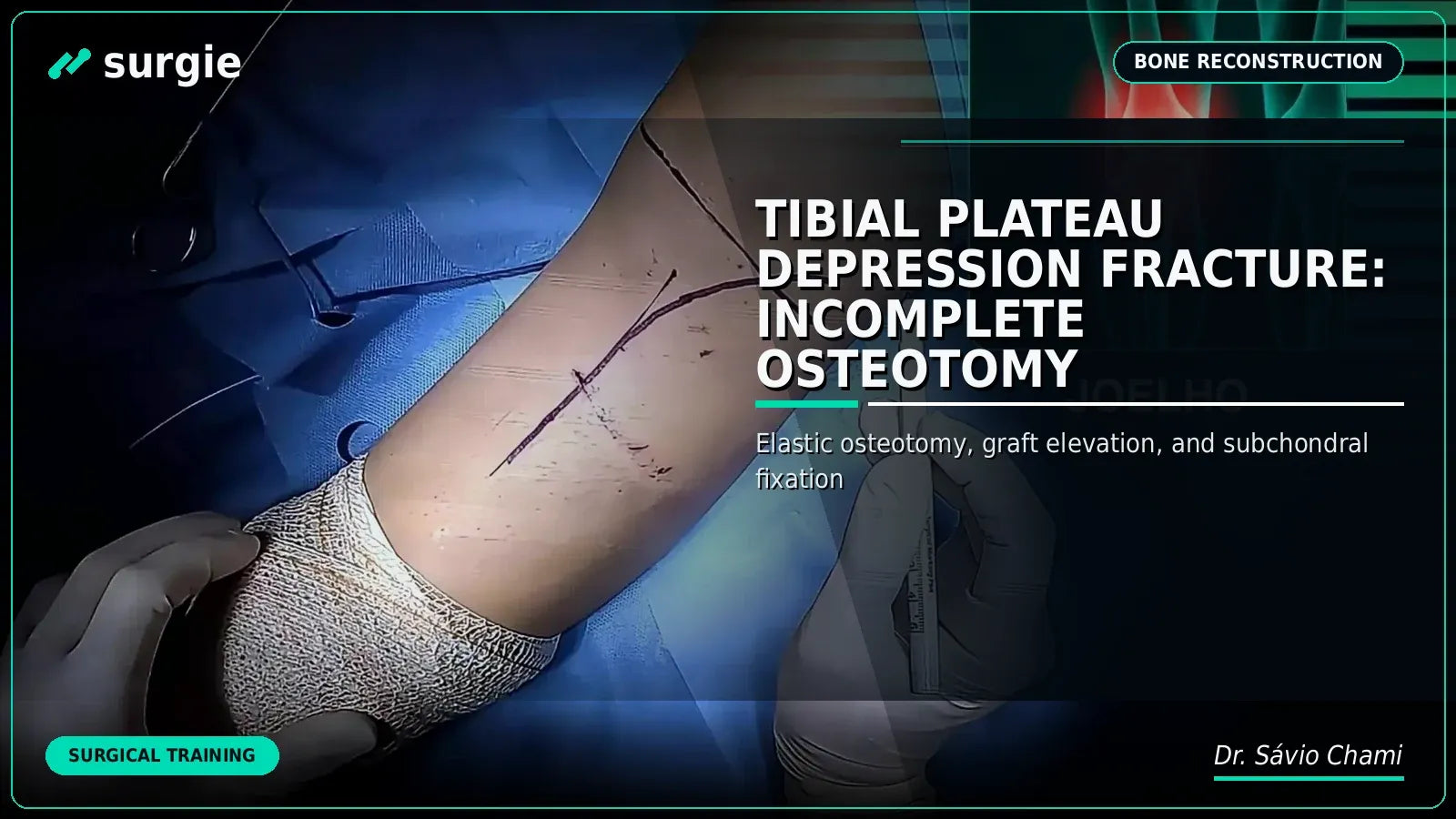Tibial Plateau Depression Fracture: Incomplete Osteotomy