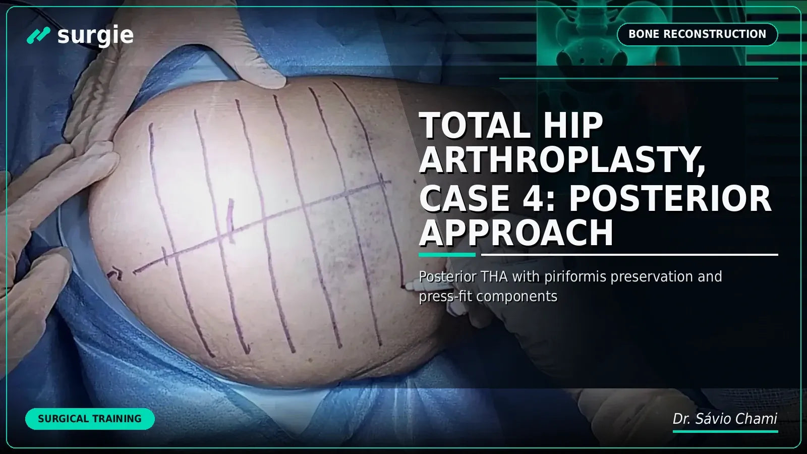 Total Hip Arthroplasty, Case 4: Posterior Approach
