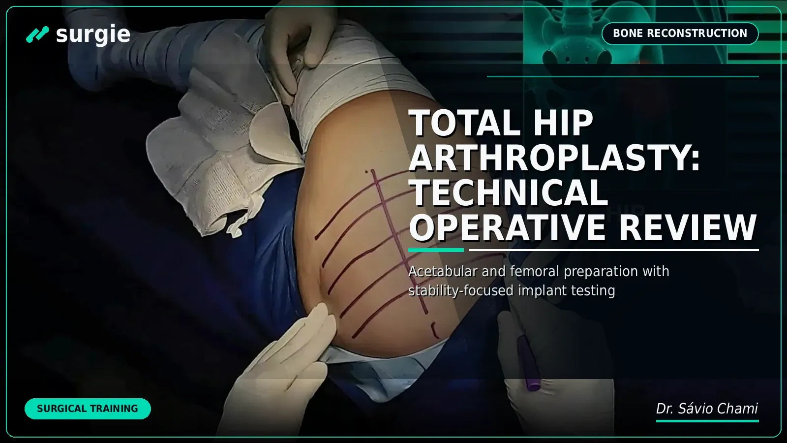 Total Hip Arthroplasty: Technical Operative Review