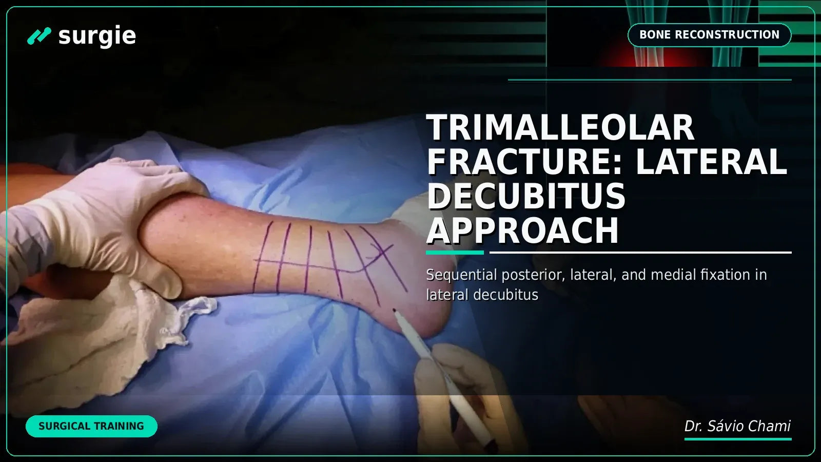 Trimalleolar Fracture: Lateral Decubitus Approach