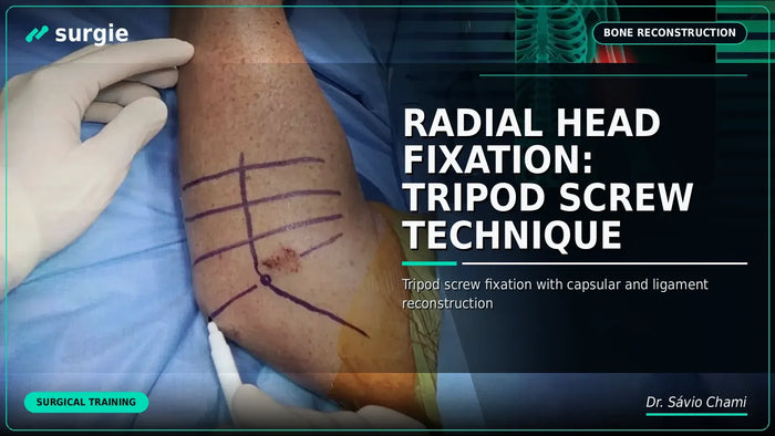 Radial Head Fixation: Tripod Screw Technique